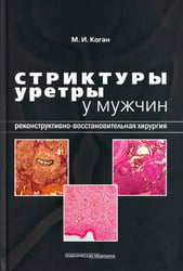 Стриктуры уретры у мужчин