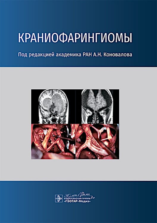 Дополнительное изображение книги «Краниофарингиомы»