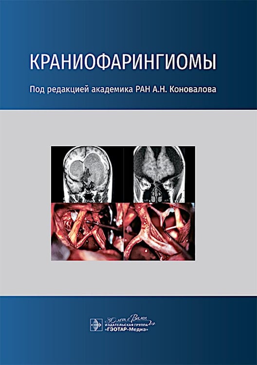 Обложка книги «Краниофарингиомы» — None, ISBN 9785970488164