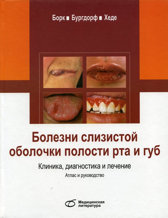 Дополнительное изображение книги «Болезни слизистой оболочки полости рта и губ. Клиника, диагностика и лечение. Атлас и руководство»