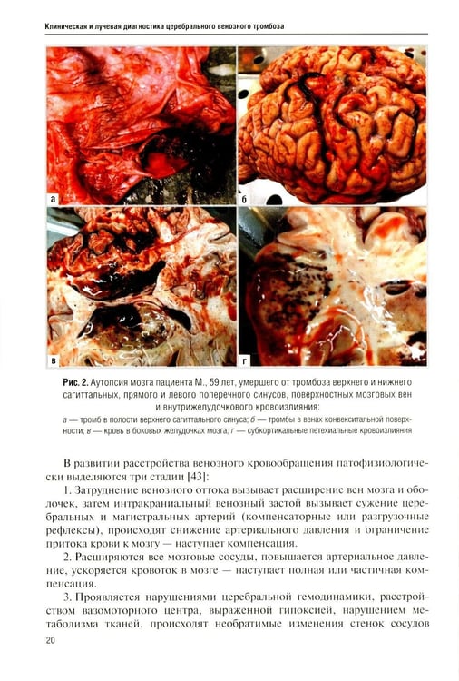 Дополнительное изображение книги «Клиническая и лучевая диагностика церебрального венозного тромбоза: Учебное пособие»