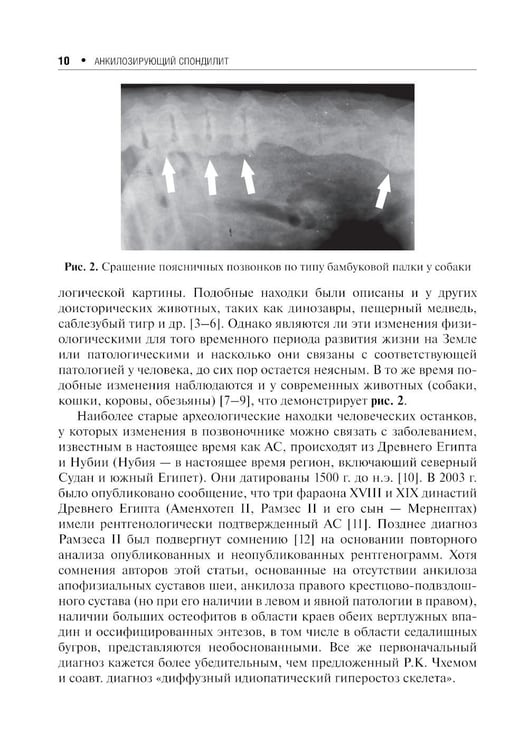 Дополнительное изображение книги «Анкилозирующий спондилит. 2-е изд., перераб. и доп»