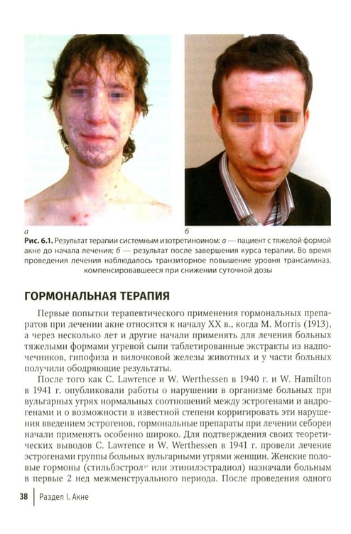 Дополнительное изображение книги «Акне и постакне: руководство для врачей»